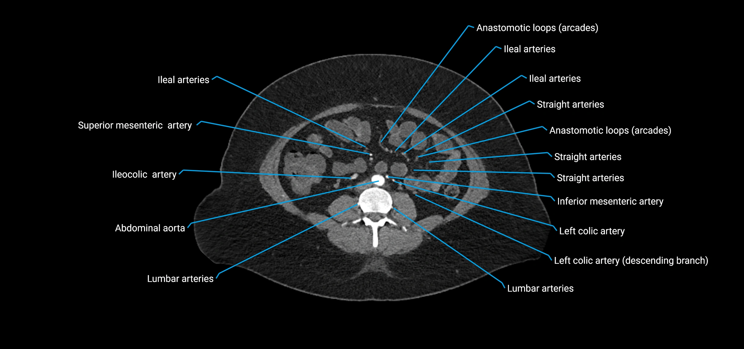 CTA abdomen axial cross sectional anatomy labelled image_120 (2).webp